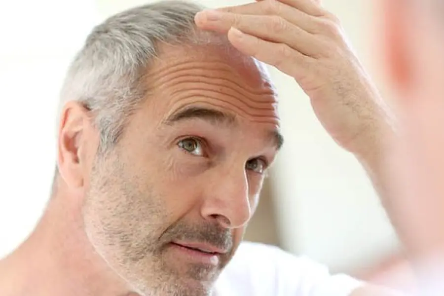 Lotta alla calvizie: tanti passi in avanti nel corso degli ultimi anni