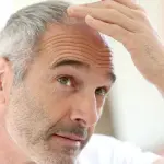 Lotta alla calvizie: tanti passi in avanti nel corso degli ultimi anni